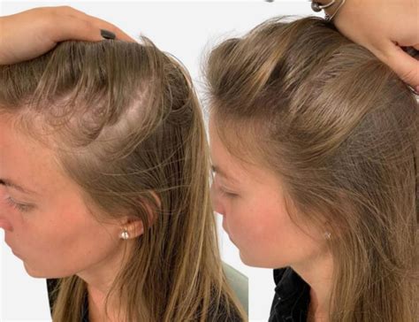 fue hair transplant for women.